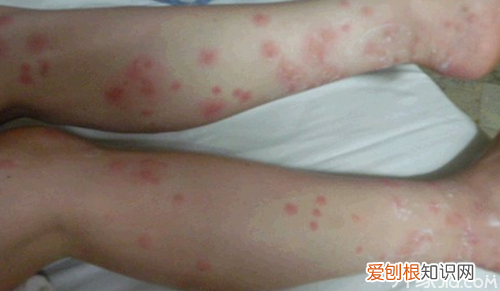 【生活资讯】臭虫咬了怎么治简单实用,不看别后悔！