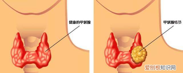 左面甲状腺结节 左甲状腺结节有什么症状《快来了解一下吧》