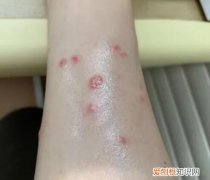 人得猫癣可怕吗图片 ，人得猫癣可怕吗会传染吗？