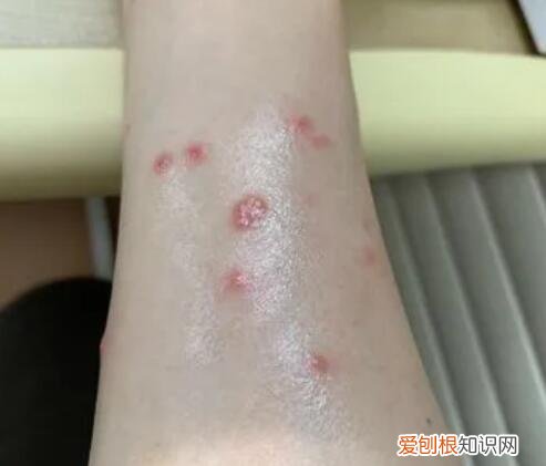 人得猫癣可怕吗图片 ，人得猫癣可怕吗会传染吗？