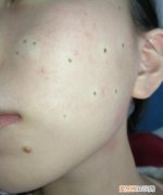 点痣后为什么不能洗脸，去痣后多久可以洗脸 详解几大注意事项呢