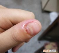 指甲脱落还会长，指甲掉了还能长出来吗
