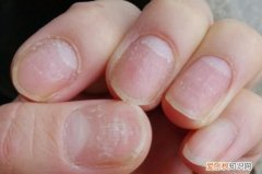 指甲凹凸不平怎么回事，指甲盖凹凸不平是什么原因