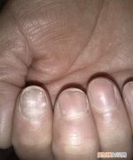 指甲白点是什么，指甲里出现白点是怎么回事儿