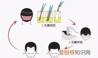 植发可以用腋毛，体毛可以种植到头发上吗