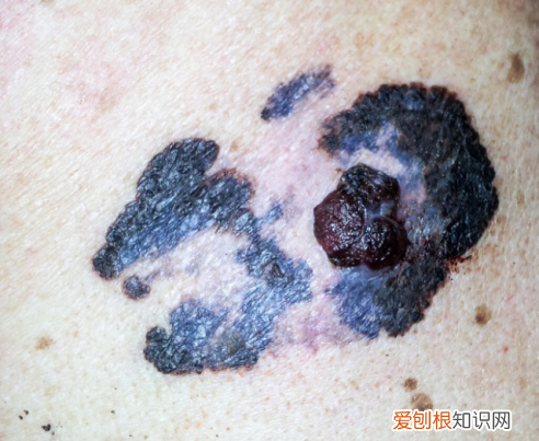 黑色素痣与普通痣区别怎么切除 区分痣与黑色素瘤五种方法