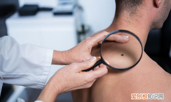 黑色素痣与普通痣区别怎么切除 区分痣与黑色素瘤五种方法