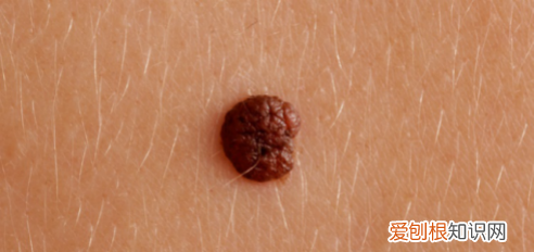 黑色素痣与普通痣区别怎么切除 区分痣与黑色素瘤五种方法