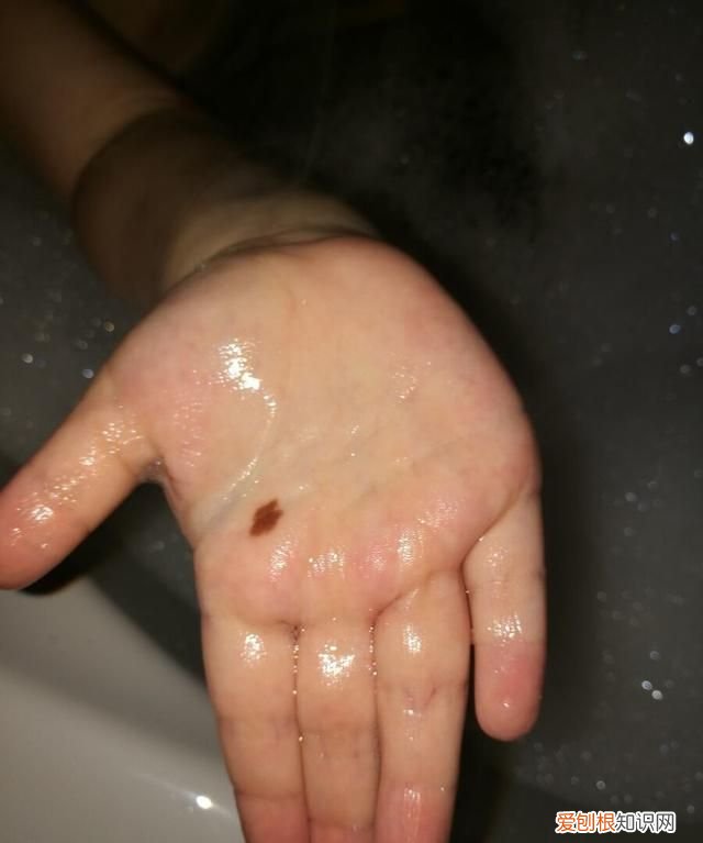 黑色素痣与普通痣区别怎么切除 区分痣与黑色素瘤五种方法