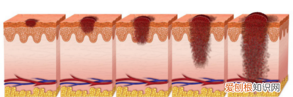 黑色素痣与普通痣区别怎么切除 区分痣与黑色素瘤五种方法