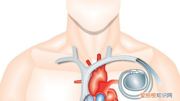 临时起搏器能用多久,国产临时心脏起搏器上市公司