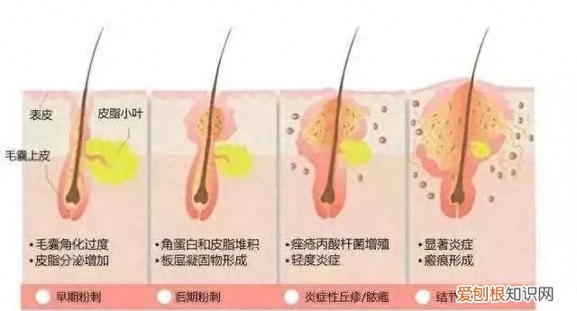 痤疮吃避孕药疗程