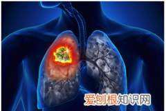 粒子植入最长能活多久，放射性粒子植入治疗肺癌