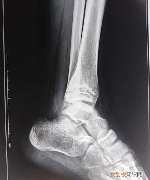 X光片如何看骨痂,怎样才能知道骨折好了