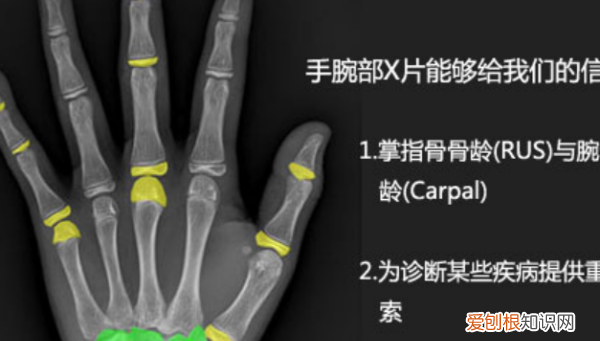 TW3一RUS骨龄是指什么