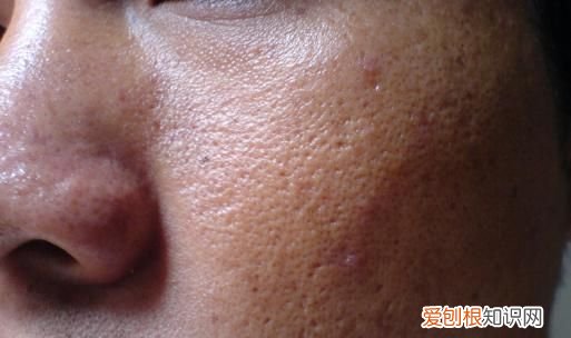 碘伏洗头头发有伤害