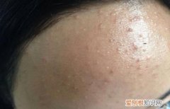 碘伏洗头头发有伤害