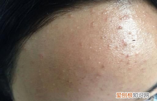 碘伏洗头头发有伤害