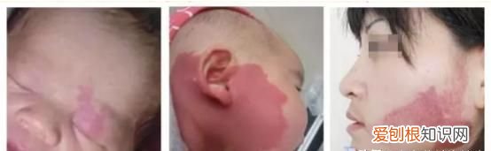 鲜红斑痣对身体有影响