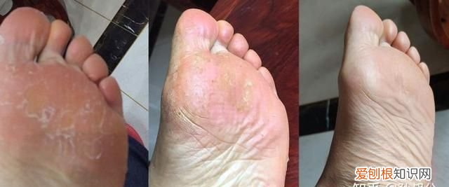 夏天脚臭穿鞋也有味道 穿鞋脚臭怎么办 教你除臭方法