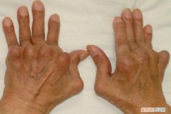 类风湿最怕的食物有哪些