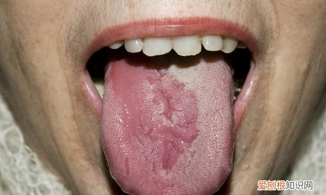 舌头长泡是什么上火