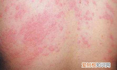 4岁男宝易过敏体质怎么能改善 过敏体质怎么改善最有效的方法
