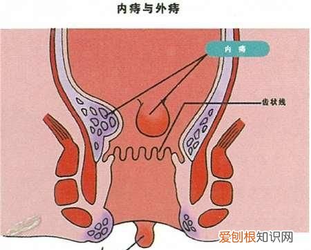 十人九痔看看痔疮是如何形成的,十人九痔痔疮是怎么形成