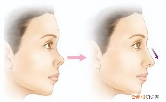 塌鼻子鼻孔大怎么做好看