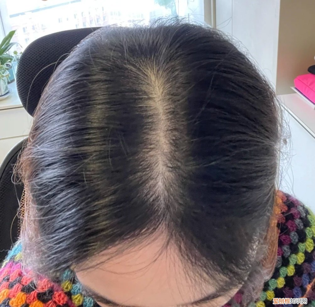 霸王洗发水哪款生发效果好?脱发达人养发的辛酸史记录