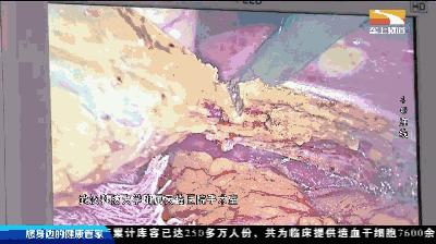 现场直播腹腔镜胆囊切除术全过程!