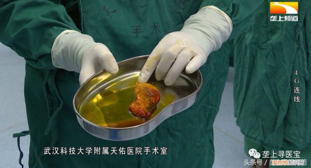 腹腔镜手术视频