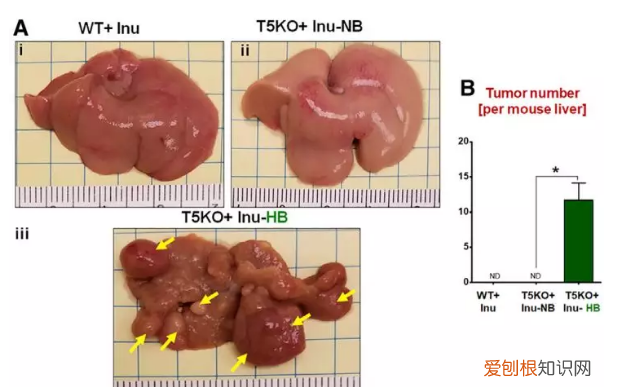可溶性膳食纤维导致肝癌 可溶性膳食纤维吃多了会得肝癌