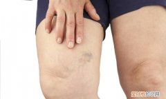 膝蓋窩附近有紅血絲什么原因