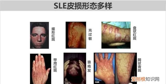 红斑狼疮lge低会引发皮疹吗 红斑狼疮危象