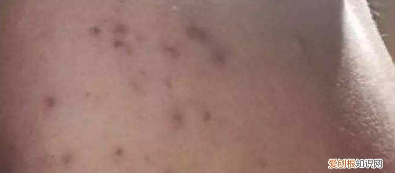 怎样去痘印最快